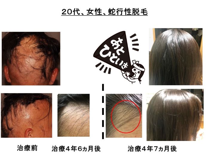 円形脱毛症　病院